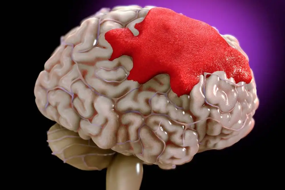 What Is Subarachnoid Hemorrhage